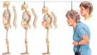 Постменопаузальный остеопороз: как предупредить перелом кости?